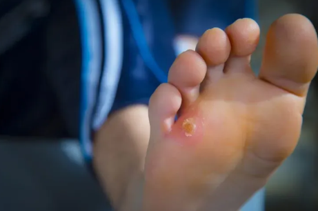 How to Tell If Your Foot Wound Needs Medical Attention